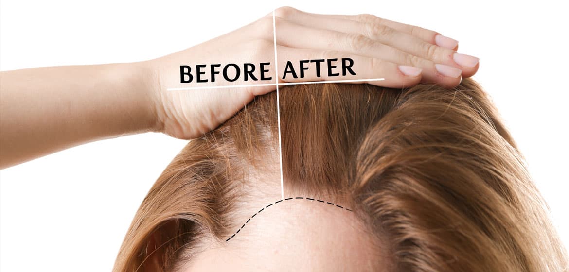 Hair Restoration in Pacifica