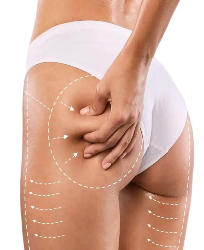 Radiesse Buttock Augmentation